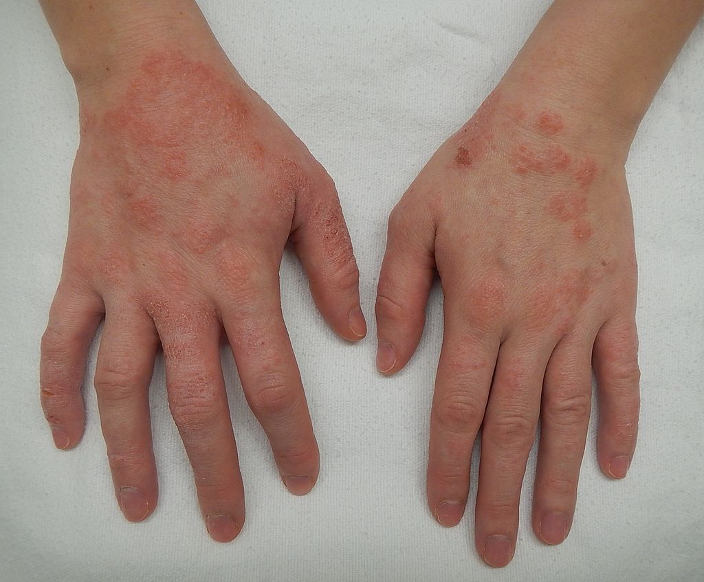 hand dermatitis